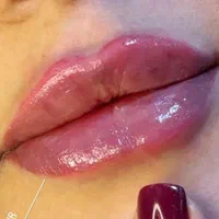 جشنواره هایفوتراپی،ژل، بوتاکس،لیزر در کلینیک پزشکی|خدمات آرایشگری و زیبایی|رشت, معلم|دیوار