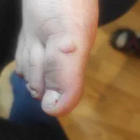 زگیل تناسلی