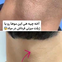 لیزر موهای زائد لیزر آقایان لیزر بانوان لیزر خانم|خدمات آرایشگری و زیبایی|اصفهان, سعادت‌آباد|دیوار