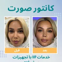 زاویه سازی صورت/فیلر و نانو فت/ در یک جلسه|خدمات آرایشگری و زیبایی|تهران, دروس|دیوار