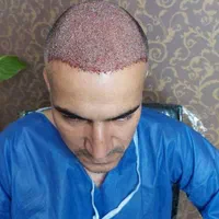 کاشت مو،کاشت ابرو، کاشت ریش، بلفاروپلاستی