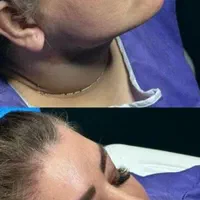 تخلیه چربی یا لیپو ساکشن
