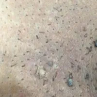 درمان زگیل،تبخال تناسلی خانمهاو آقایان،درمطب متخصص|خدمات آرایشگری و زیبایی|تبریز, |دیوار