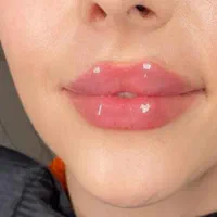 ژل لب هایفولیفت نخ زاویه چانه بوتاکس فیلربینی لیزر|خدمات آرایشگری و زیبایی|مشهد, فرهنگ|دیوار
