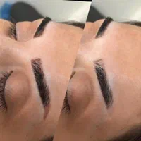 خدمات لیزر،تاتو،خال،ریمور