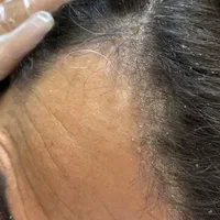 اسکراب اسکالپ موی سر(درمان)|خدمات آرایشگری و زیبایی|تهران, نیروی هوایی (پیروزی)|دیوار