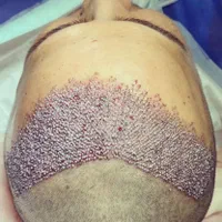 کاشت موی طبیعی