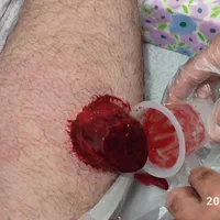 حجامت و فصد خون تخصصی با بیش از هفده سال سابقه|خدمات آرایشگری و زیبایی|سنندج, |دیوار