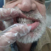 دندان مصنوعی متحرک (تحویل ۳ روزه)|خدمات آرایشگری و زیبایی|کرمانشاه, |دیوار