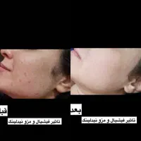 فقط برای 5نفر اول فیشیال ویژه 700|خدمات آرایشگری و زیبایی|شیراز, شهرک والفجر|دیوار