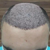 جشنواره کاشت مو ،ابرو و ریش