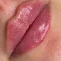 تزریق ژل و بوتاکس