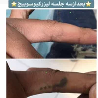 مرکز ریمو،پاک کردن،ریموو تتوابرو.بدن.خط چشم بالیزر|خدمات آرایشگری و زیبایی|شیراز, فرهنگ شهر|دیوار