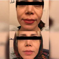 هایفوتراپی جوانسازی لیفت صورت غبغب آف به مدت محدود|خدمات آرایشگری و زیبایی|قم, شهرک قدس|دیوار