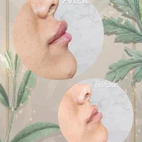 جشنواره تزریق ژل و بوتاکس و PRP برداشت خال|خدمات آرایشگری و زیبایی|تهران, بلوار کشاورز|دیوار