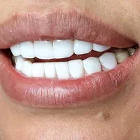 کامپوزیت زیبایی طرح لبخند
