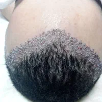 کاشت مو ۳ روزه -کاشت ابرو بدون جراحی و باجراحی|خدمات آرایشگری و زیبایی|خرم‌آباد, |دیوار