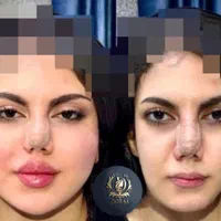 تزریق تخصصی ژل ومادلینگ خلیجی واروپایی وبوتاکس|خدمات آرایشگری و زیبایی|کرمانشاه, |دیوار