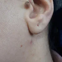 از بین بردن انواع خال،زگیل،میخچه،زگیل تناسلی|خدمات آرایشگری و زیبایی|خمینی‌شهر, |دیوار