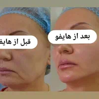 هایفوتراپی جوانسازی لیفت صورت غبغب آف به مدت محدود|خدمات آرایشگری و زیبایی|قم, شهرک قدس|دیوار