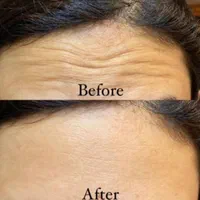 تزریق ژل بوتاکس لیزر هایفو لیفت صورت فیلرلب بیکینی|خدمات آرایشگری و زیبایی|تهران, صادقیه|دیوار