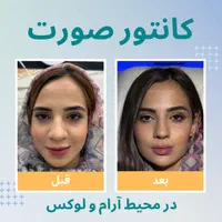 زاویه سازی صورت/فیلر و نانو فت/ در یک جلسه|خدمات آرایشگری و زیبایی|تهران, دروس|دیوار