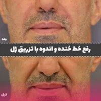ژل لب / بوتاکس چشم گربه ای / فیلر /مادلینگ|خدمات آرایشگری و زیبایی|کرج, جهان‌شهر|دیوار