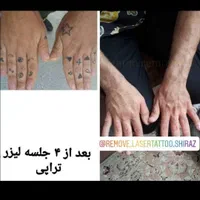 ریمو،پاک کردن،ریموو تتوابرو.بدن.کک مک بالیزر|خدمات آرایشگری و زیبایی|شیراز, عفیف‌آباد|دیوار