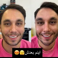 تزریق ژل بوتاکس لیفت صورت وشقیقه آنزیم مزو|خدمات آرایشگری و زیبایی|تهران, صادقیه|دیوار