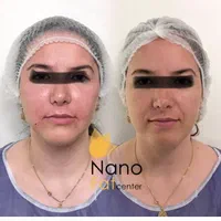 تزریق چربی صورت دست با سن بیکینی در کلینیک تخصصی|خدمات آرایشگری و زیبایی|تهران, صادقیه|دیوار