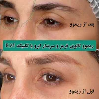 تخفیف ریموو تتو ابرو، خط چشم و لب در مرکز پوست غرب|خدمات آرایشگری و زیبایی|تهران, باغ فیض|دیوار