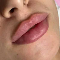 کلینیک پوست و زیبایی ژل لب/فیلرگونه/زاویه/بوتاکس|خدمات آرایشگری و زیبایی|قم, صفائیه|دیوار