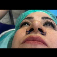 بلفاروپلاستی اتو پلاستی لیفت|خدمات آرایشگری و زیبایی|اهواز, نادری|دیوار