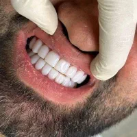 ( ایمپلنت بدون جراحی پانچ از ۶ تومن )|خدمات آرایشگری و زیبایی|اصفهان, سرچشمه|دیوار