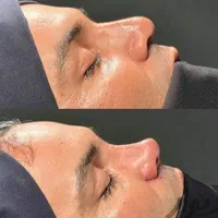 بلفاروپلاستی ،سانترال لب،لیفت ابرو،چربی صورت|خدمات آرایشگری و زیبایی|تهران, هروی|دیوار