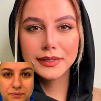 جراحی زیبائی بینی عمل بینی لیفت شقیقه پلک گوش غبغب|خدمات آرایشگری و زیبایی|اصفهان, مرداویج|دیوار