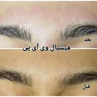 جشنواره تخفیف ویژه لیزر،ژل،بوتاکس،کلیه خدمات پزشکی|خدمات آرایشگری و زیبایی|ساری, |دیوار