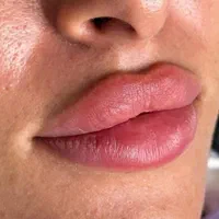 تزریق ژل وبوتاکس،نخ کاگ یالیفت صورت،اموزش|خدمات آرایشگری و زیبایی|تهران, شهرک شریعتی|دیوار