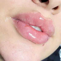 جوانسازی با تزریق ژل و بوتاکس|خدمات آرایشگری و زیبایی|تبریز, |دیوار