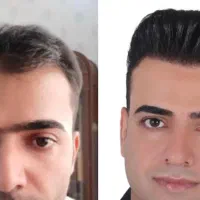 کاشت مو ب روش شیرازی درمشهد|خدمات آرایشگری و زیبایی|مشهد, احمدآباد|دیوار