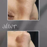 مدل پاکسازی و فیشال پوست با ۴ سال سابقه کار