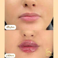 فیلرژل لب بوتاکس فیلر مادلینگ لیزرموهای زائدفشیال|خدمات آرایشگری و زیبایی|تهران, نیروی هوایی (پیروزی)|دیوار