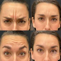 جوانسازی BOTOX بوتاکس