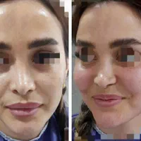 افر ویژه‌ی فیلر/بوتاکس/prpبا قیمت باورنکردنی|خدمات آرایشگری و زیبایی|تهران, دروازه شمیران|دیوار