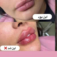 تزریق ژل و بوتاکس پک مادلینگ، مزونیدلینگ ۵۰٪تخفیف