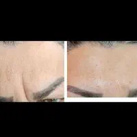 تزریق ژل،بوتاکس،خال برداری،مزوی مو و صورت|خدمات آرایشگری و زیبایی|بندر کنگان, |دیوار