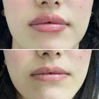 ژل /بوتاکس فیلر لب روسی اموزش بوتاکس آنزیم چربی|خدمات آموزشی|خرم‌آباد, |دیوار