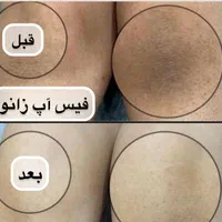 رفع تیرگی بدن در مطب پزشکی با دستگاه|خدمات آرایشگری و زیبایی|شیراز, قدوسی غربی|دیوار