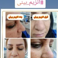 آنزیم ژل لب.بینی.غعبغب. ژل های گلوله شده چربی سوز|خدمات آرایشگری و زیبایی|خرم‌آباد, |دیوار