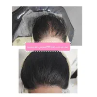 جشنواره فیلر ژل بوتاکس prpمزوتراپی لیزر توسط پزشک|خدمات آرایشگری و زیبایی|کرمان, |دیوار